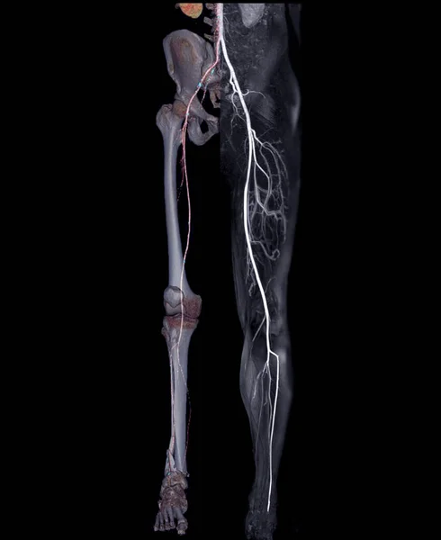 Compare Cta Femoral Artery Run Magnetic Resonance Angiography Peripheral Runoff — Stock Photo, Image