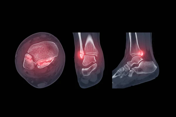 Scan Ankle Joint Showing Fracture Ankle Joint — Stock Photo, Image