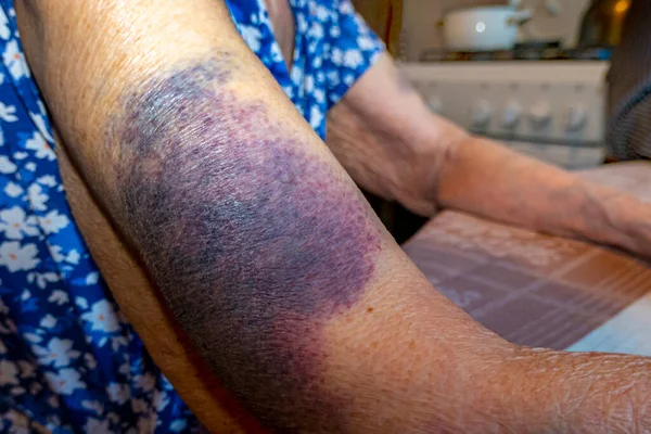 一个有瘀伤的老年妇女的手 — 图库照片