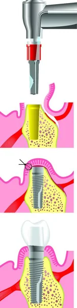 Dental Surgery Graphic Vector Illustration — Vector de stock