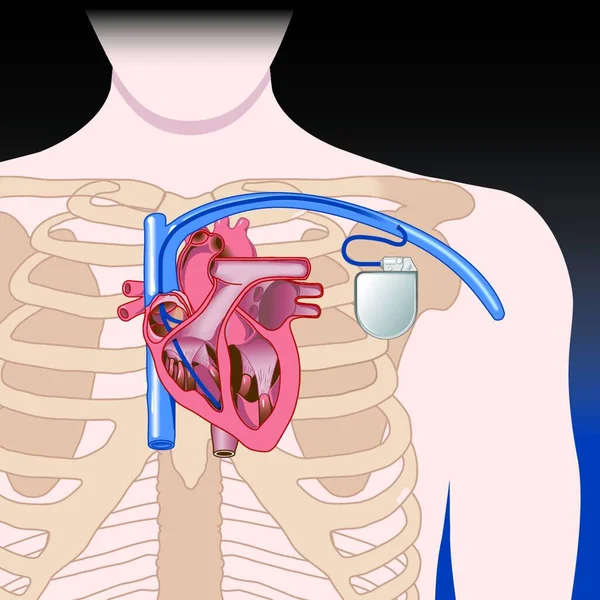 Illustration Stimulateur Cardiaque — Image vectorielle