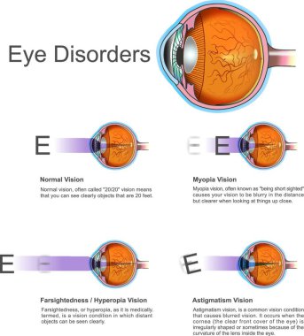 Göz Bozuklukları, vektör çizimi basit tasarım