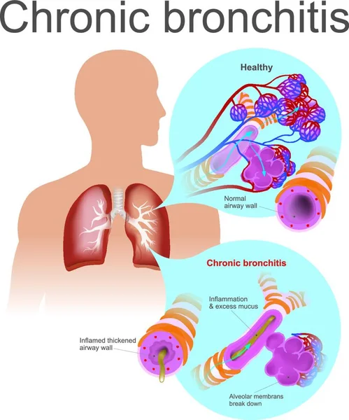 慢性支气管炎 病媒图解简单设计 — 图库矢量图片
