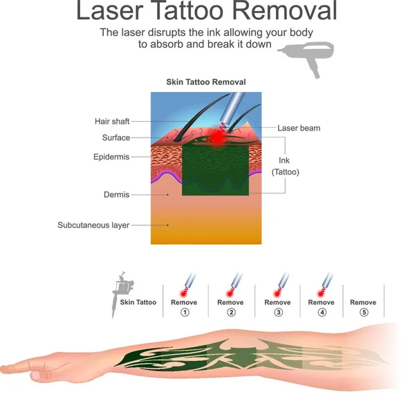 Удаление Лазерных Татуировок Векторная Иллюстрация Простая Конструкция — стоковый вектор