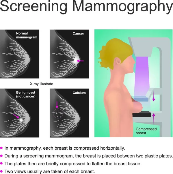 Mamografía Detección Ilustración Vectorial Diseño Simple — Vector de stock