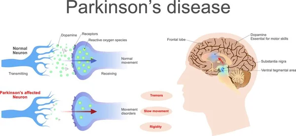 Ziekte Van Parkinson Vector Illustratie Eenvoudig Ontwerp — Stockvector
