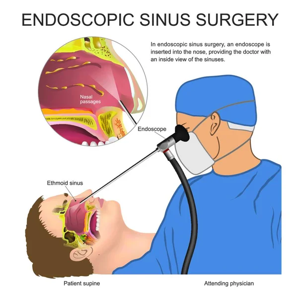 Cirugía Endoscópica Sinusal Ilustración Vectorial Diseño Simple — Vector de stock