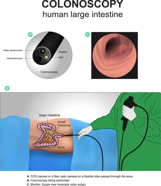 大腸内視鏡のコンセプト ベクターイラストシンプルなデザイン — ストックベクタ