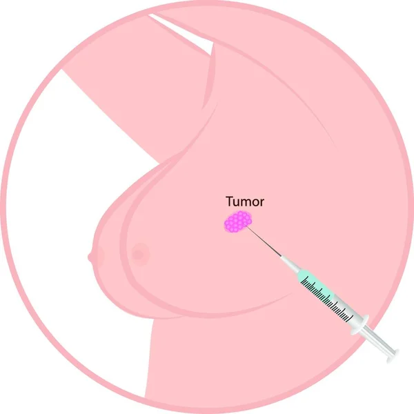 Brustkrebs Tumor Grafische Illustration — Stockvektor