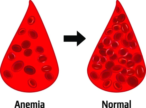 Anemia Cantidad Normal Glóbulos Rojos — Vector de stock
