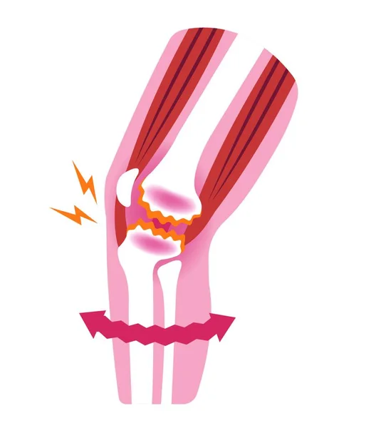 Dor Nas Articulações Joelho Gonartrose Osteoartrite Artrose Joelho Ilustração Plana —  Vetores de Stock