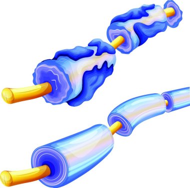 Myelin bozulması, grafik vektör çizimi 