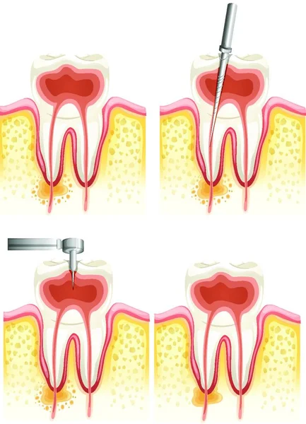 Ilustração Vetor Ícone Canal Radicular Dentário —  Vetores de Stock