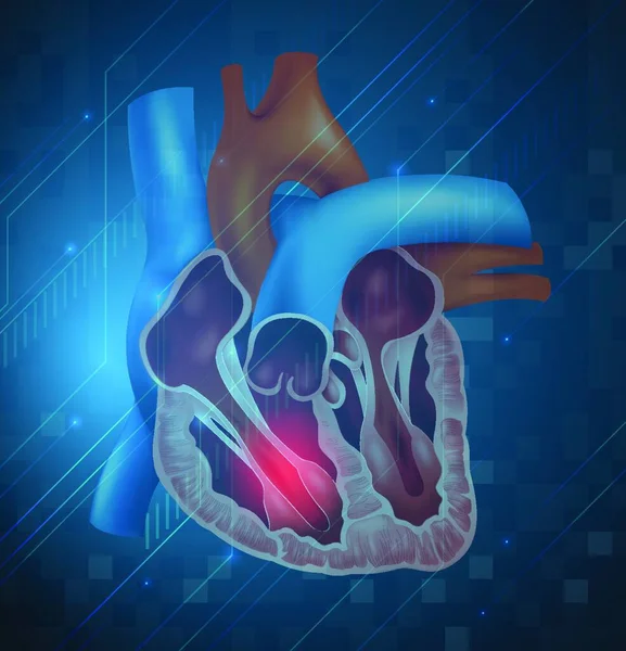 Illustration Crise Cardiaque — Image vectorielle