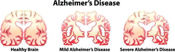 Illustration Der Alzheimer Krankheit — Stockvektor