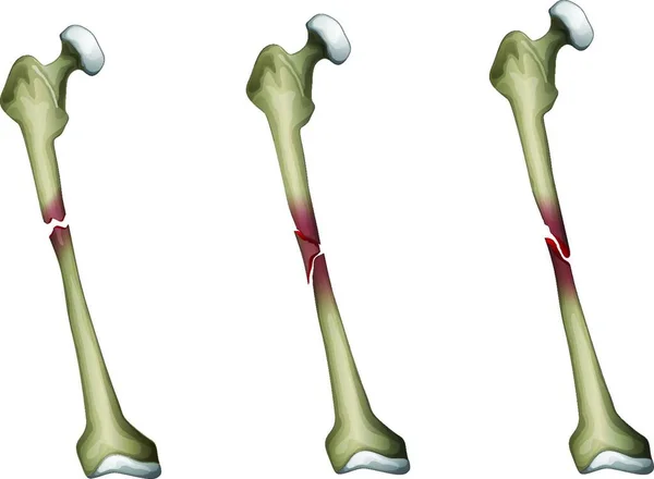 Illustration Bone Fracture — Stock Vector