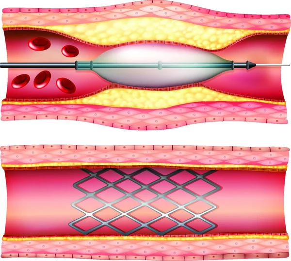 Illustration Stent Angioplasty — Stock Vector