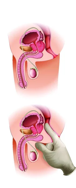 Illustrazione Vettoriale Del Cancro Alla Prostata — Vettoriale Stock