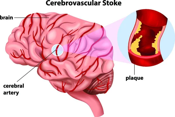 Ilustração Vetorial Acidente Vascular Cerebral —  Vetores de Stock