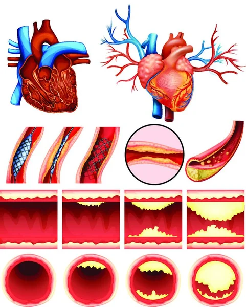 Heart Cholesterol Vector Illustration — Stock Vector