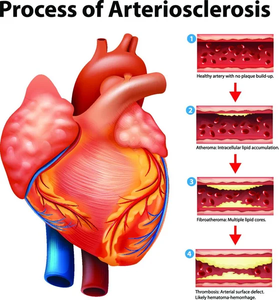 Proceso Arteriosclerosis Vector Ilustración — Vector de stock