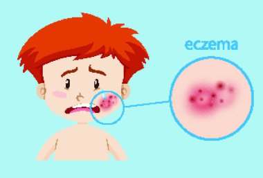 Egzama vektör çizimi olan hasta çocuk. 