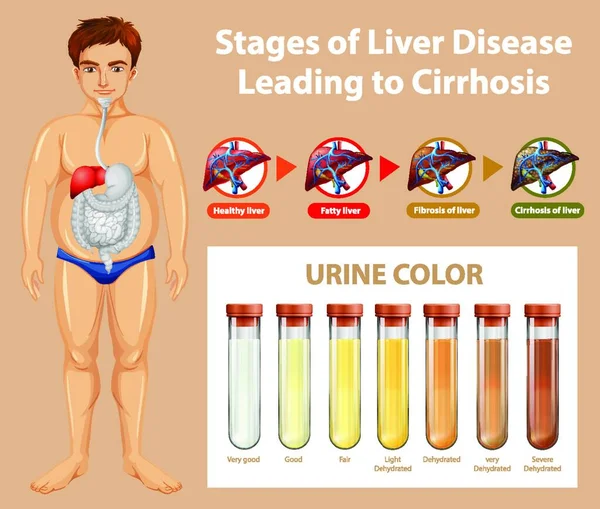 肝病导致肝硬化的各个阶段 — 图库矢量图片