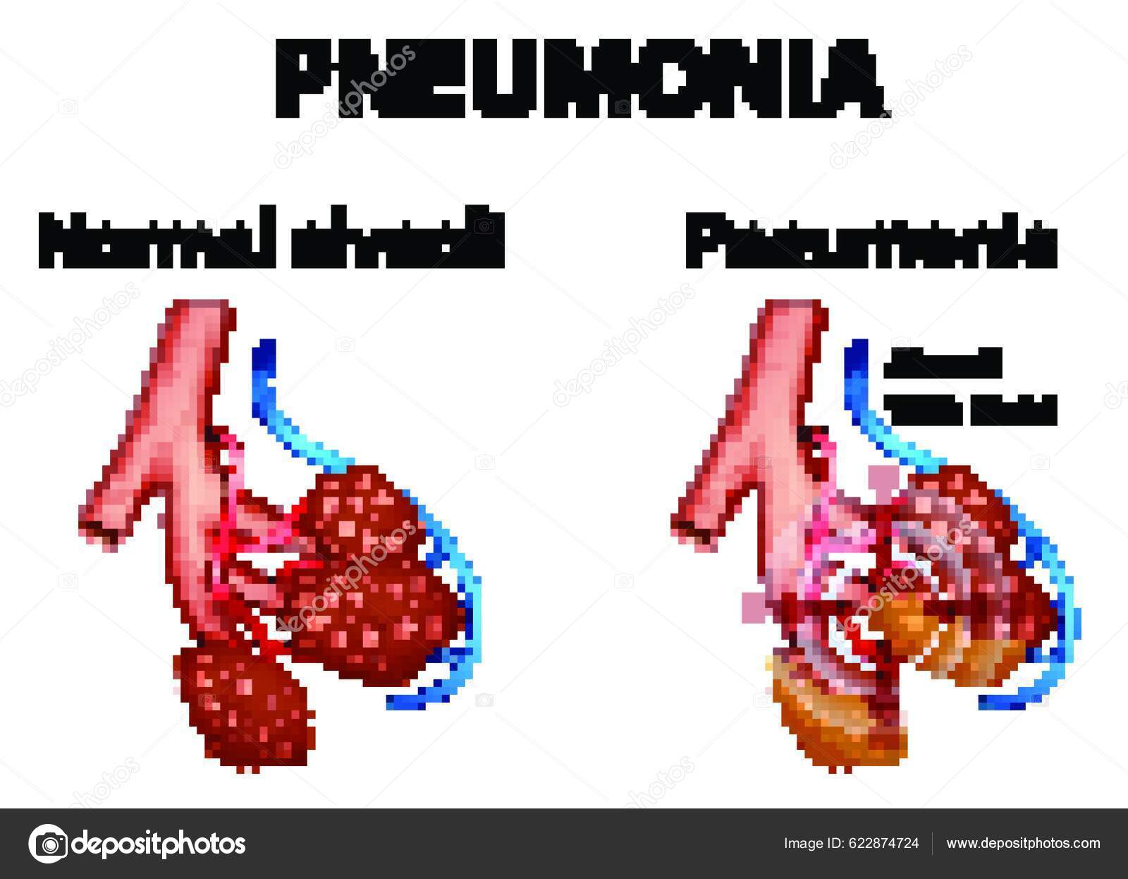 Human Anatomy Showing Pneumonia Stock Vector by ©YAY_Images 622874724