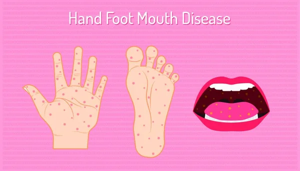 Hand Foot Mouth Disease Enteroviruses Ev71 Name Virus Careful Your — Stock Vector