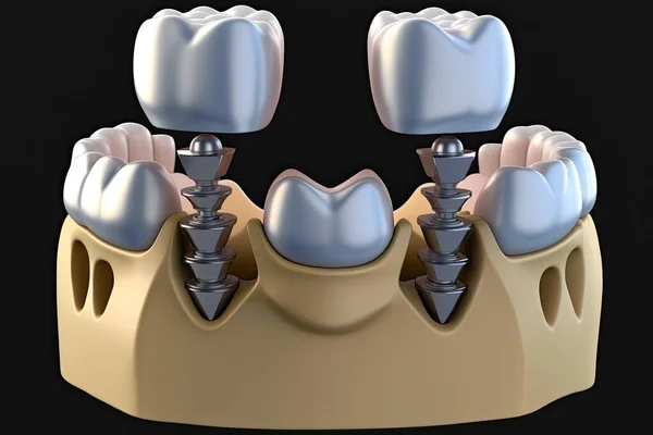 Crown Support Implanted Teeth Isolated Black Background — Stock Photo, Image