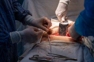 Bir cerrah bir hastanın midesini kesiyor. Cerrah hastanın hayatını kurtarmak için çalışırken sahne yoğun ve dramatik. Diğer cerrahlar ve sağlık personeli yakından izliyor.