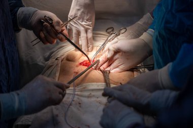 Bir grup cerrah bir hastaya ameliyat yapıyor. Cerrahlar görevlerine odaklandığı için sahne yoğun ve ciddi. Hasta masanın üzerinde yatıyor.