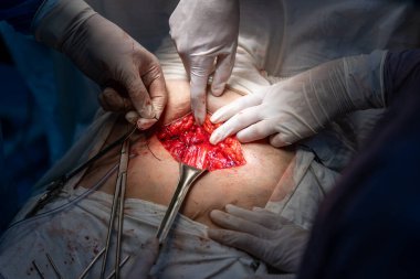 Bir grup cerrah bir hastaya ameliyat yapıyor. Hastanın midesi açık ve cerrahlar mideyi kesmek için neşter kullanıyorlar. Sahne yoğun ve ciddi.