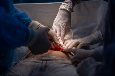 Bir grup cerrah bir hastaya ameliyat yapıyor. Cerrahlar görevlerine odaklandığı için sahne yoğun ve ciddi. Hasta masanın üzerinde yatıyor.