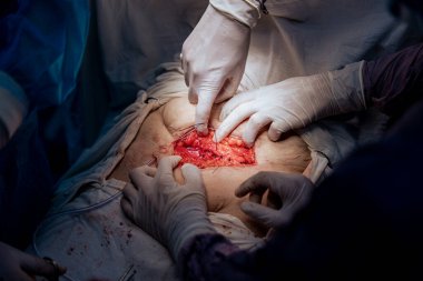 Bir grup cerrah bir hastaya ameliyat yapıyor. Hastanın midesi açık ve cerrahlar üzerinde çalışıyor.