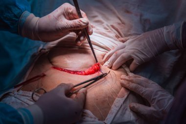 Bir cerrah bir hastanın midesini kesiyor. Hasta hastanede ve ameliyat bir grup doktor tarafından gerçekleştiriliyor.