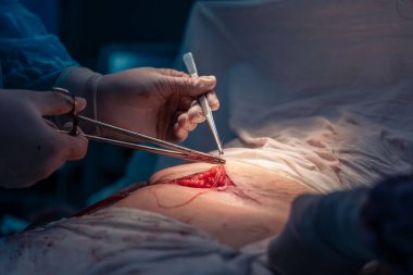 Bir cerrah bir hastanın midesini kesiyor. Hasta hastanede ve prosedür uygulanıyor.