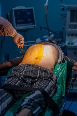 Bir adam bir hastanın karnından ameliyat yapıyor. Hasta yeşil beyaz bir hastane yatağında yatıyor.