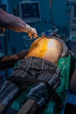 Bir adam bir doktor tarafından ameliyat ediliyor. Doktor adamın midesinde bir sopa tutuyor.