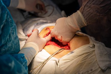 Bir insan bir insanın karnını deşiyor. Mavi bir ameliyat elbisesi giyiyor.