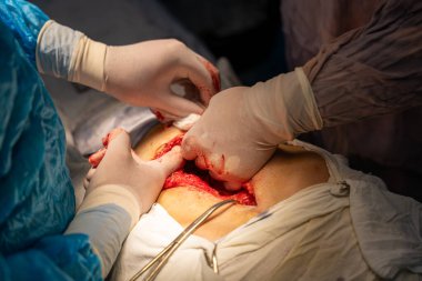 Bir cerrah bir hastanın midesini kesiyor. Cerrah hayat kurtaran bir prosedür uygularken sahne yoğun ve dramatik.