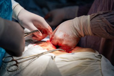 Bir cerrah bir hastanın midesini kesiyor. Cerrah hayat kurtaran bir prosedür uygularken sahne yoğun ve dramatik. Hasta büyük ihtimalle çok acı çekiyor.