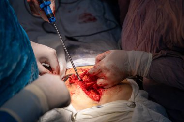 Bir cerrah bir hastanın midesini kesiyor. Hastanın kanaması var ve cerrah karnını kesmek için neşter kullanıyor.