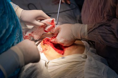 Bir cerrah bir hastanın midesini kesiyor. Hastanın kanaması var ve cerrah eldiven giyiyor.