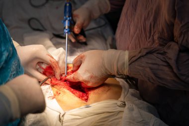 Bir cerrah bir hastanın midesini kesiyor. Hastanın kanaması var ve cerrah karnını kesmek için neşter kullanıyor.