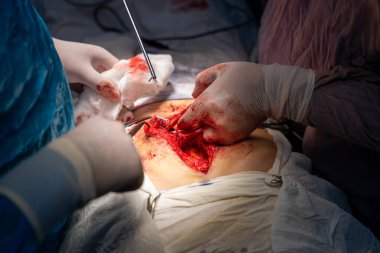 Bir cerrah bir hastanın midesini kesiyor. Hastanın kanaması var ve cerrah karnını kesmek için neşter kullanıyor.