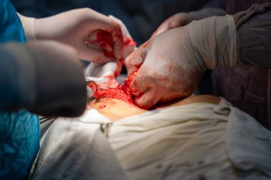 Bir grup cerrah bir hastaya ameliyat yapıyor. Cerrahlar görevlerine odaklandığı için sahne yoğun ve ciddi. Hasta bir hastane yatağında.