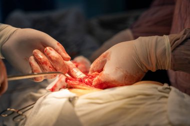 Bir cerrah bir hastanın vücudunu kesiyor. Cerrah hassas ve potansiyel olarak hayat kurtaran bir prosedür uygularken sahne yoğun ve dramatik. Hasta büyük ihtimalle çok acı çekiyor.