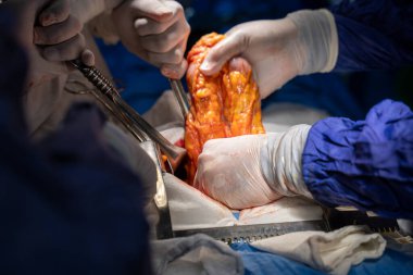 Hastane, cerrah, ameliyat, ameliyat, doktor, cerrahi, hasta, ilaç, kişi, hemşire, sağlık, takım çalışması, mide ameliyatı.