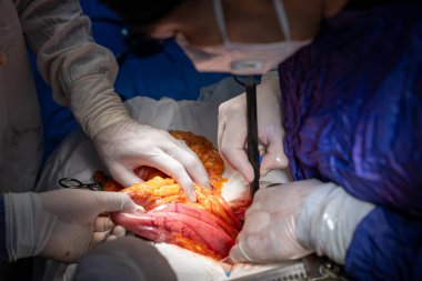 Hastane, cerrah, ameliyat, ameliyat, doktor, cerrahi, hasta, ilaç, kişi, hemşire, sağlık, takım çalışması, mide ameliyatı.